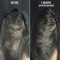 Successful FUE Hair Transplant for the Scalp After Skin Graft